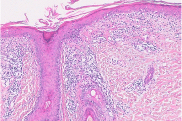 SLE; Systemic lupus erythematosus