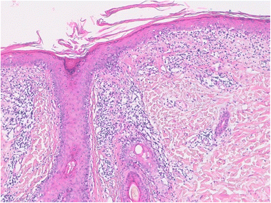 SLE; Systemic lupus erythematosus